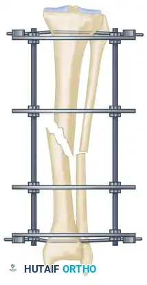 ILIZAROV EXTERNAL FIXATION FOR TIBIAL SHAFT FRACTURES Surgical Diagram