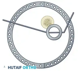 ILIZAROV EXTERNAL FIXATION FOR TIBIAL SHAFT FRACTURES Surgical Diagram