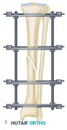 ILIZAROV EXTERNAL FIXATION FOR TIBIAL SHAFT FRACTURES Surgical Diagram