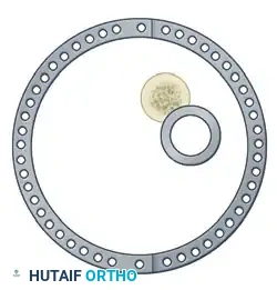 ILIZAROV EXTERNAL FIXATION FOR TIBIAL SHAFT FRACTURES Surgical Diagram