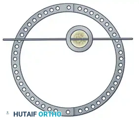 ILIZAROV EXTERNAL FIXATION FOR TIBIAL SHAFT FRACTURES Surgical Diagram