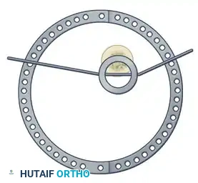 ILIZAROV EXTERNAL FIXATION FOR TIBIAL SHAFT FRACTURES Surgical Diagram