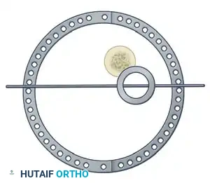 ILIZAROV EXTERNAL FIXATION FOR TIBIAL SHAFT FRACTURES Surgical Diagram
