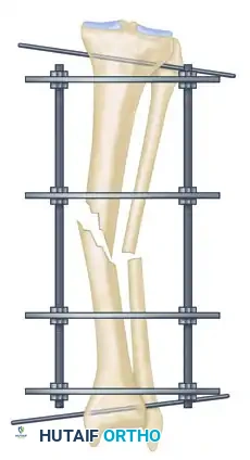 ILIZAROV EXTERNAL FIXATION FOR TIBIAL SHAFT FRACTURES Surgical Diagram