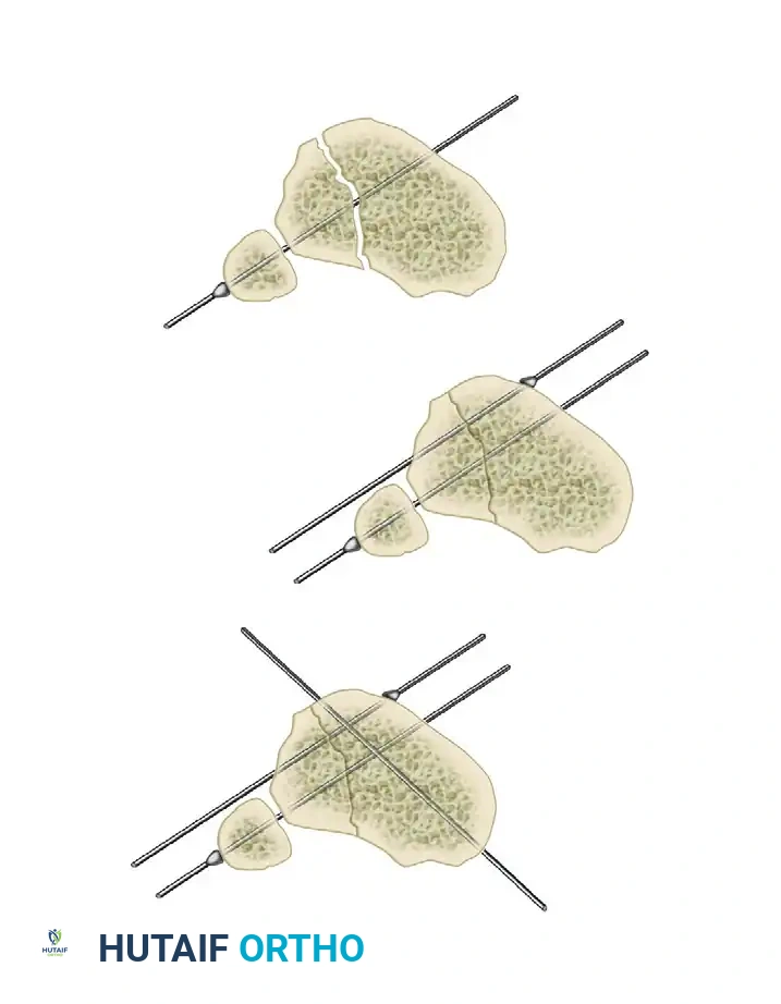 ILIZAROV EXTERNAL FIXATION FOR TIBIAL SHAFT FRACTURES Surgical Diagram