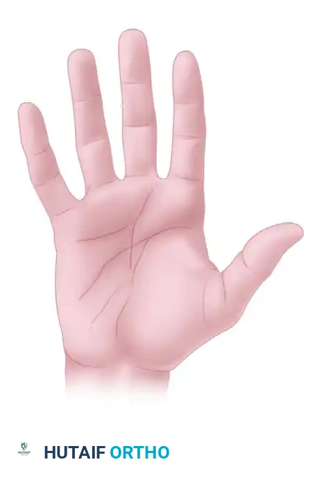 INCISION AND DRAINAGE OF DEEP FASCIAL SPACE INFECTION Surgical Diagram