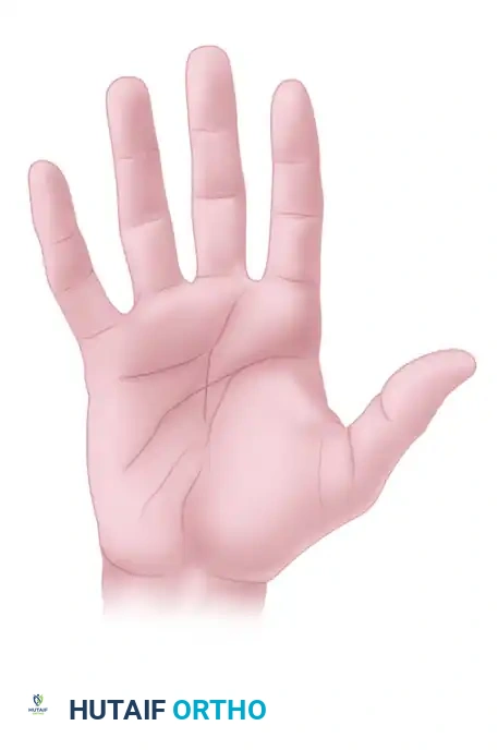 INCISION AND DRAINAGE OF DEEP FASCIAL SPACE INFECTION Surgical Diagram