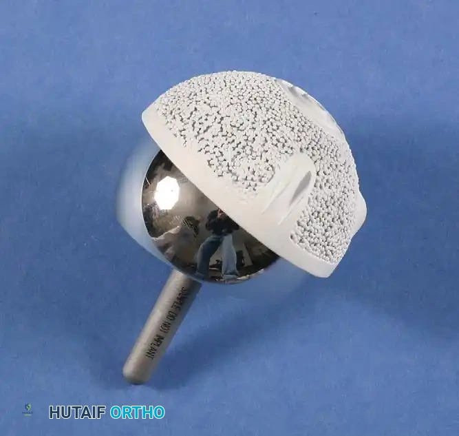 Fig. 7-39 Birmingham Hip Resurfacing implants (Smith & Nephew, Memphis, Tenn). Cast cobalt-chromium alloy implants. Femoral component is ﬁ xed with cement. Acetabular shell has cast porous surface with hydroxyapatite coating.
