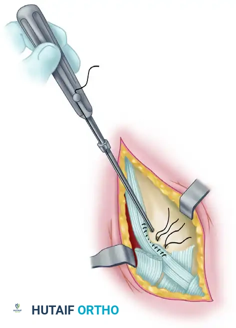 INJURIES OF THE FLEXOR TENDONS Surgical Diagram