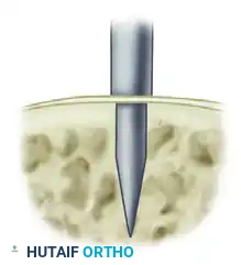 INJURIES OF THE FLEXOR TENDONS Surgical Diagram