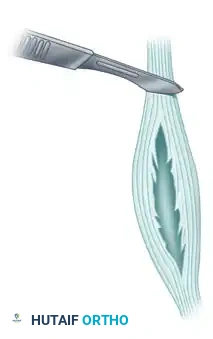 INJURIES OF THE FLEXOR TENDONS Surgical Diagram