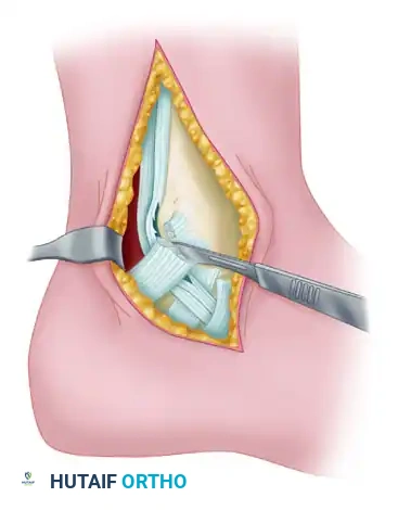 Operative Management of Flexor and Peroneal Tendon Injuries