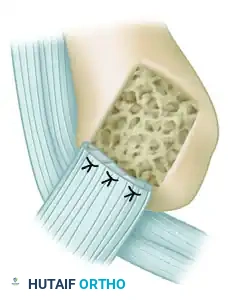 INJURIES OF THE FLEXOR TENDONS Surgical Diagram