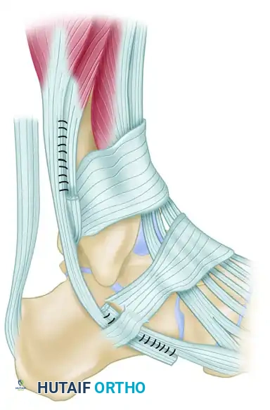 INJURIES OF THE FLEXOR TENDONS Surgical Diagram