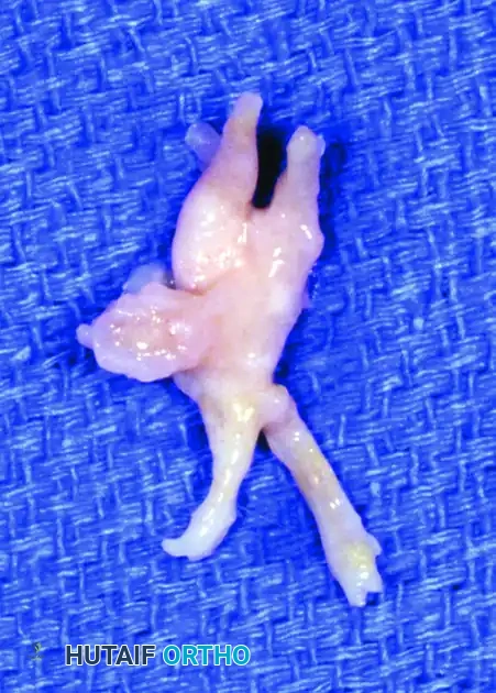 Interdigital Neuroma Excision: The Dorsal Approach