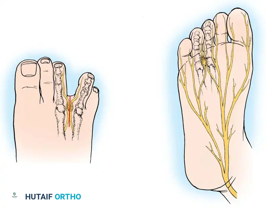 Interdigital Neuroma (Morton's Toe): Comprehensive Surgical Management