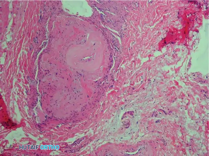 Fig. 83-7 Pathological ﬁ ndings of interdigital neuroma. A, Interdigital nerve is greatly thickened by perineural ﬁ brous tissue (hematoxylin and eosin stain).