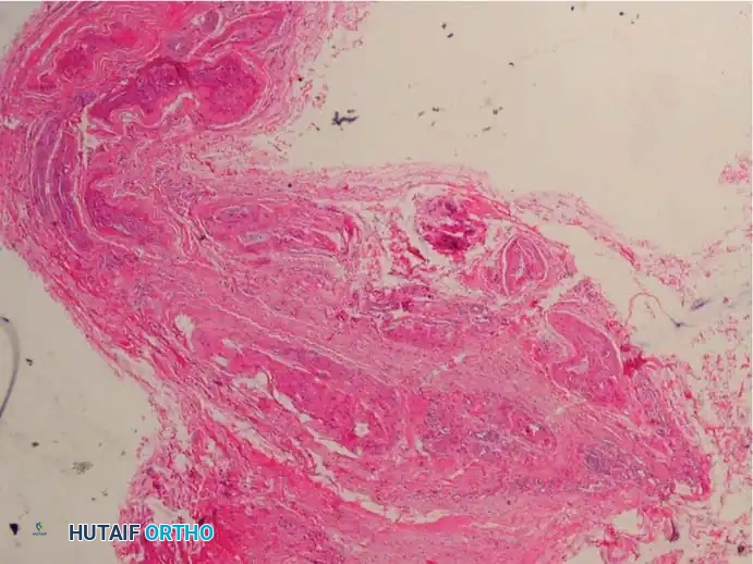 Fig. 83-7 Pathological ﬁ ndings of interdigital neuroma. B, Vessels in region often show degenerative changes such as fraying and duplication of internal elastic lamina (Verhoeff-van Gieson stain).