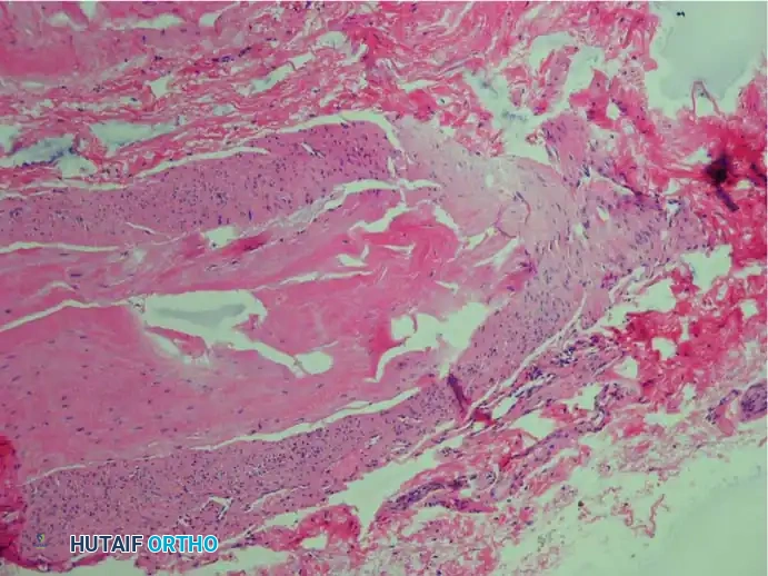 Fig. 83-7 Pathological ﬁ ndings of interdigital neuroma. C, Some axons are missing, and others show degenerative changes (Bielschowsky stain).
