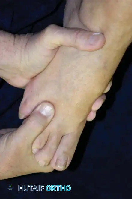 Clinical examination of the web space