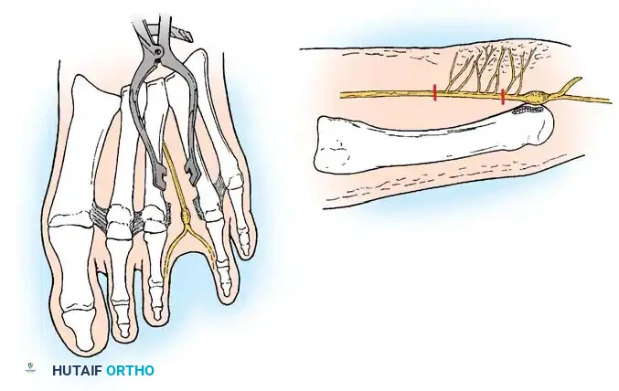 Histological overview of interdigital neuroma