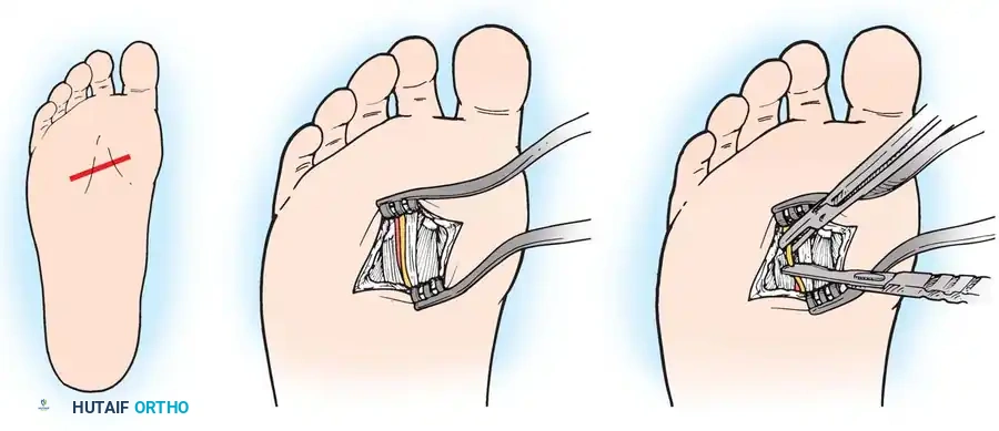 Diagram of plantar approach incision and exposure