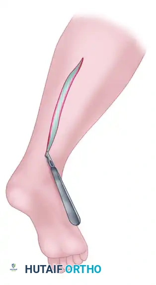 Harvesting of nerve through single longitudinal incision