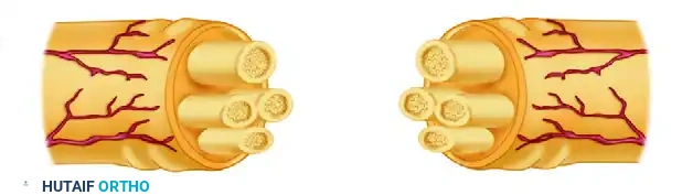 Neuroma excision and fascicular dissection completed