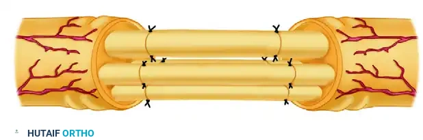 Nerve grafts sutured in place