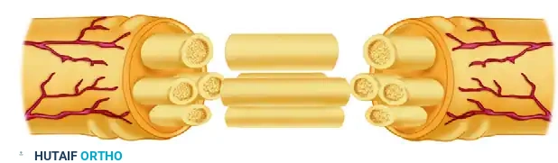 Nerve grafts placed between nerve ends