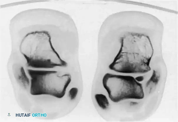 INTERNAL DERANGEMENTS Surgical Diagram