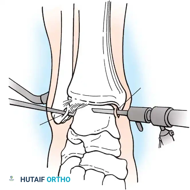 INTERNAL DERANGEMENTS Surgical Diagram