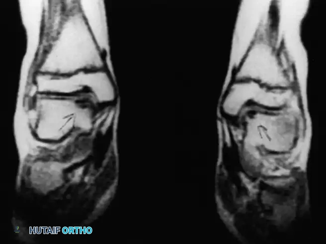 INTERNAL DERANGEMENTS Surgical Diagram
