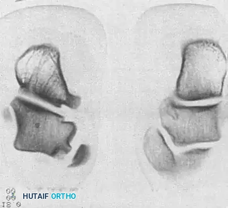 INTERNAL DERANGEMENTS Surgical Diagram