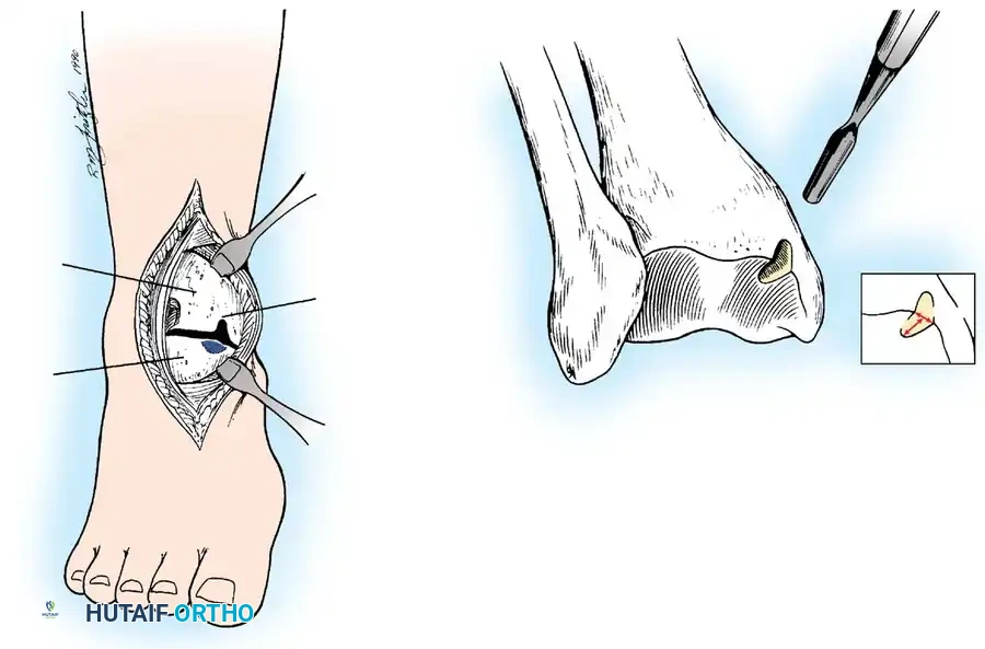 INTERNAL DERANGEMENTS Surgical Diagram