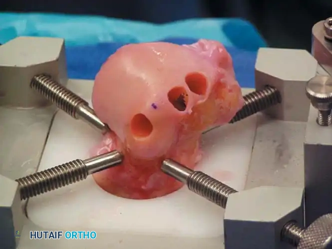INTERNAL DERANGEMENTS Surgical Diagram