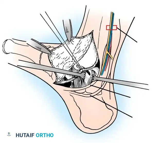 INTERNAL DERANGEMENTS Surgical Diagram