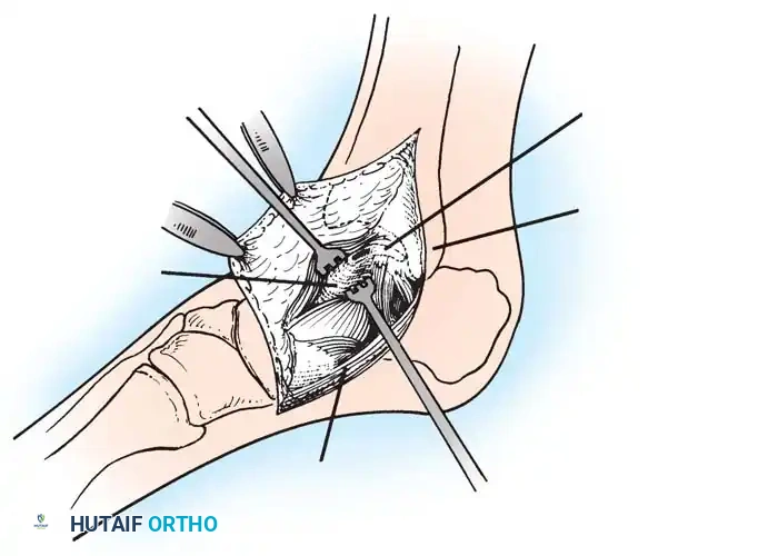 INTERNAL DERANGEMENTS Surgical Diagram