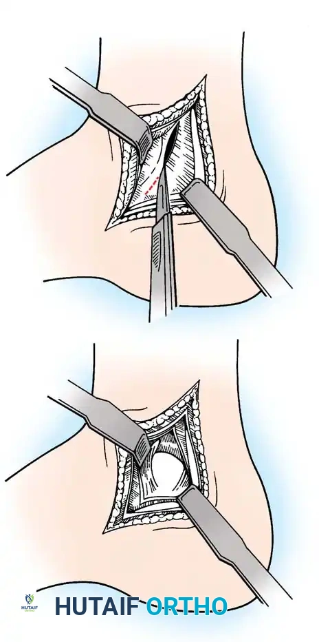 INTERNAL DERANGEMENTS Surgical Diagram