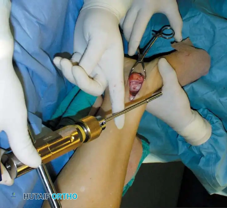 INTERNAL DERANGEMENTS Surgical Diagram