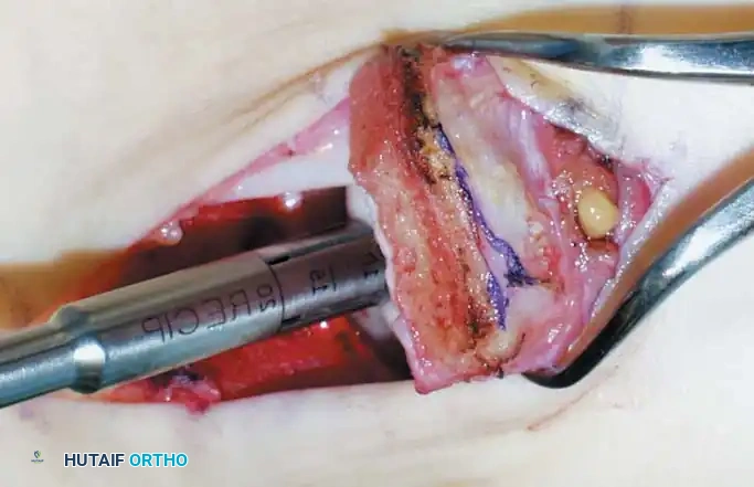 INTERNAL DERANGEMENTS Surgical Diagram