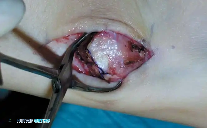 INTERNAL DERANGEMENTS Surgical Diagram
