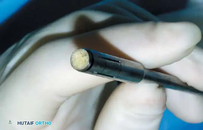 INTERNAL DERANGEMENTS Surgical Diagram