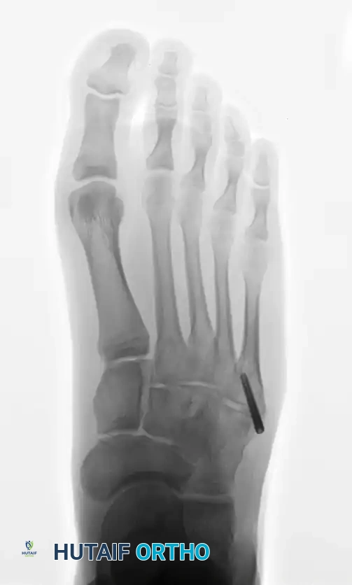 INTERNAL FIXATION WITH A MALLEOLAR SCREW Surgical Diagram