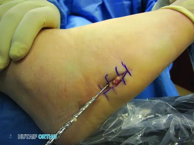 INTERNAL FIXATION WITH A MALLEOLAR SCREW Surgical Diagram