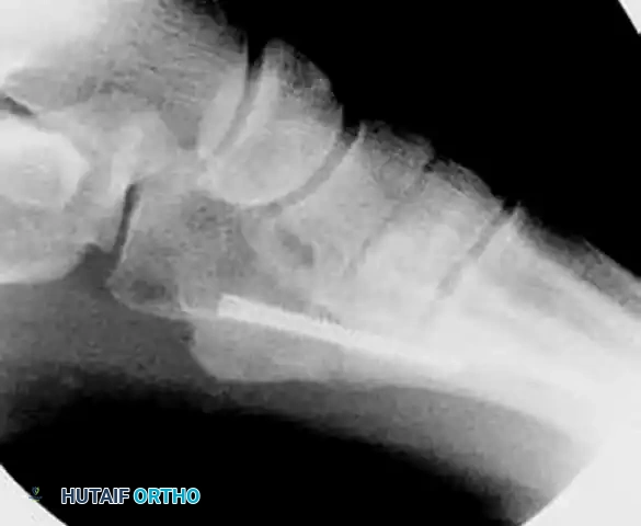 INTERNAL FIXATION WITH A MALLEOLAR SCREW Surgical Diagram