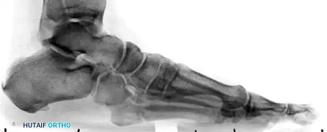 INTERNAL FIXATION WITH A MALLEOLAR SCREW Surgical Diagram
