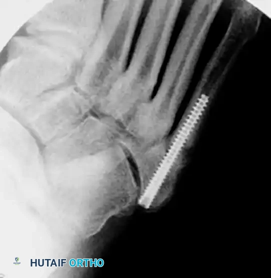 INTERNAL FIXATION WITH A MALLEOLAR SCREW Surgical Diagram