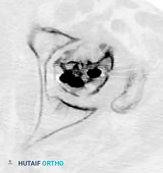 INTERTROCHANTERIC FEMORAL FRACTURES Surgical Diagram