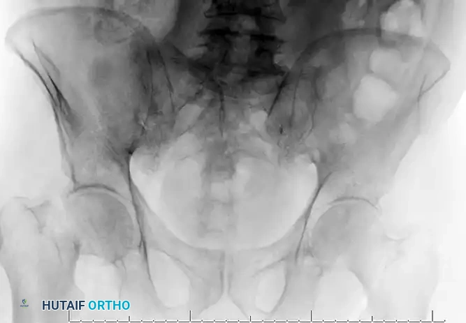 INTERTROCHANTERIC FEMORAL FRACTURES Surgical Diagram